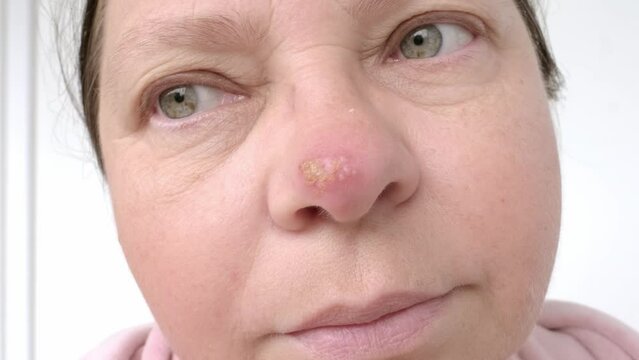 female face close-up, herpes on tip of nose, harbinger of dangerous disease damage to skin and nervous system, concept Viral Infections, Managing symptoms and treatment for a woman with herpes