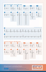 When atrial fibrillation occurs, if the initial depolarizations of a wide QRS wave and a normal QRS wave are the same, it suggests that the wide QRS wave is aberrant conduction.