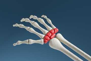 Human hand bones with pain in wrist, carpal tunnel syndrome