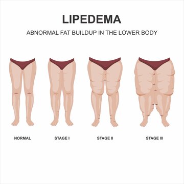 Lipedema stages and symptoms illustration