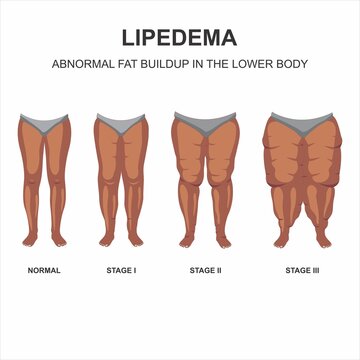Lipedema stages and symptoms illustration