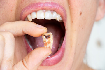 A girl in her hand holds a pulled out tooth with a black hole in the middle of the tooth close-up,...
