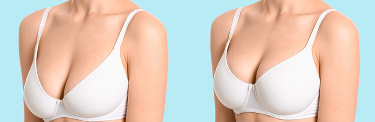 Woman before and after breast size correction on light blue background. Plastic surgery concept