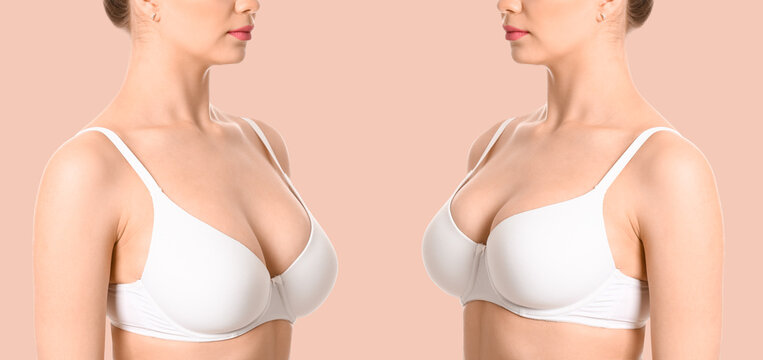 Woman before and after breast size correction on beige background. Plastic surgery concept