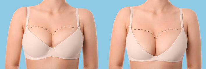 Woman with marks on her chest against white background. Concept of breast augmentation