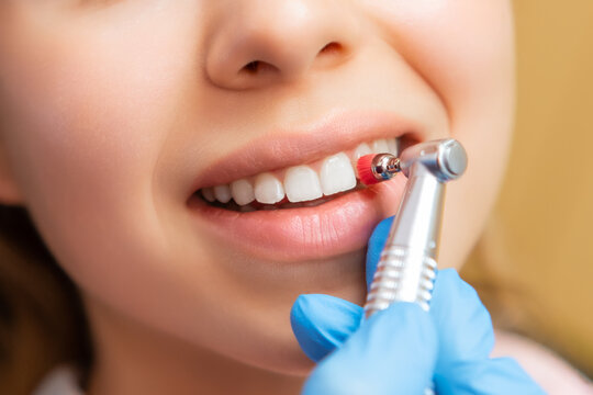 Close-up dentist performing teeth grinding procedure in dental clinic. Woman visits doctor grinding teeth to create perfect smile in private hospital