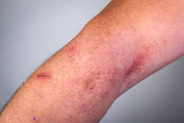 Allergy symptoms, irritation. A man's hand with red spots all over the arm on a gray background.