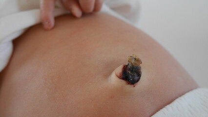 Newborn baby's belly button stump With drying umbilical cord.