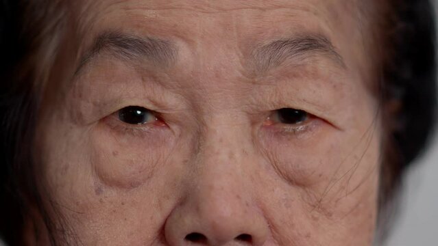 Close up of the senile cataract during eye examination. A white cloudy disc is seen in black eye circle, mature cataract, nuclear sclerosis cataract. Close up half face view