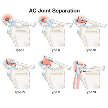 AC Joint Separation. Medically Illustration. Labeled