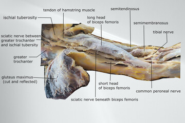 dissection image of the muscle of the thigh with showing sciatic nerve and popliteal fossa