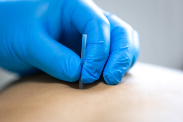 Close up of a needle and hands of physiotherapist doing a dry needling.