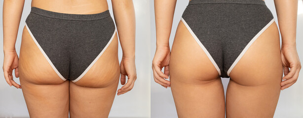 Close-up of female buttocks with cellulite before and after treatment isolated on a white background. Getting rid of excess weight, diet, healthy nutrition, training, sports, massage, scrub. Wellness