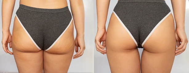 Foto op Plexiglas Close-up of female buttocks with cellulite before and after treatment isolated on a white background. Getting rid of excess weight, diet, healthy nutrition, training, sports, massage, scrub. Wellness © Mykola