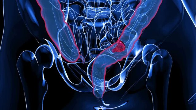 4K abstract animation of the colon cancer