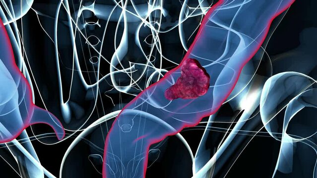 4K abstract animation of the colon cancer