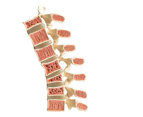 Model of the human spine isolated on a white background showing various defects in the bones and vertebrae. From bottom to top: normal vertebral bone, compression fracture, wedge fracture, osteoporose