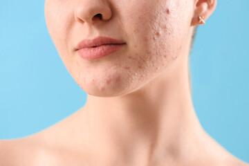 Obraz premium Teenage girl with acne problem on blue background, closeup