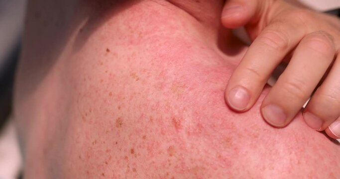 Man scratching rash on skin of his shoulder with hand closeup 4k movie. Diagnosis and treatment of allergic urticaria concept
