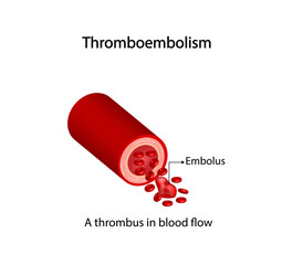 Thromboembolism. Circulating blood clot. Normal blood flow and a thrombus in blood flow, embolus. Red blood cells. Vector illustration.	 - obrazy, fototapety, plakaty