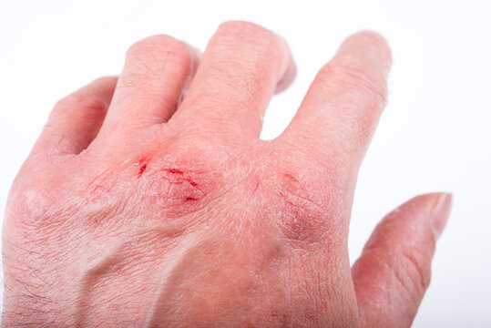 あかぎれの手の甲