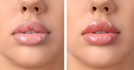 Young woman before and after treatment of dry lips, closeup