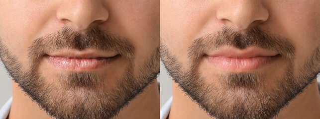 Young man before and after lip enhancement, closeup