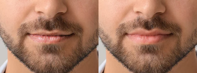 Fotobehang Young man before and after lip enhancement, closeup © Pixel-Shot