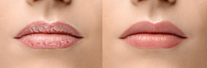 Young woman before and after treatment of dry lips, closeup