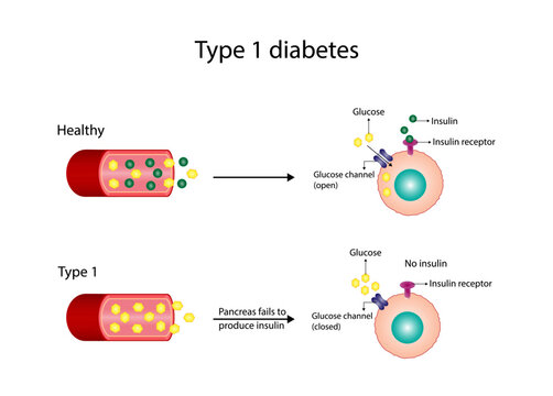 Diabetes mellitus type 1, pancreas's failure to produce enough insulin and type 2, cells fail to respond to insulin (Insulin resistance). Result in high blood glucose levels. Vector illustration