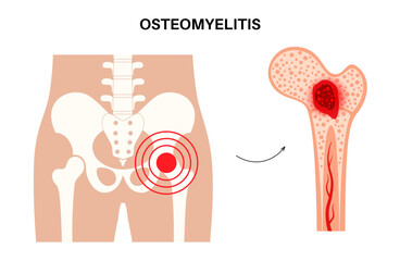 Osteomyelitis of hip