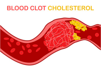 cholesterol in the blood, the cholesterol and other substances may form deposits (plaques) that collect on artery walls. Plaques can cause an artery to become narrowed or blocked.