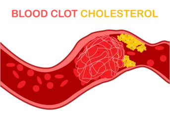 cholesterol in the blood, the cholesterol and other substances may form deposits (plaques) that collect on artery walls. Plaques can cause an artery to become narrowed or blocked. © pasakorn