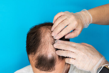 Fototapeta premium Baldness, a man is examined by a doctor in gloves on a blue background close-up.