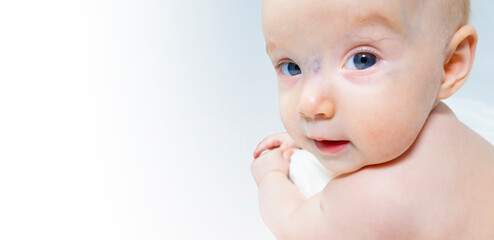 a baby with a hemangioma on his neck lies on a white background. banner with a copy space. profile of a little bald baby girl. the kid looks to the side - obrazy, fototapety, plakaty