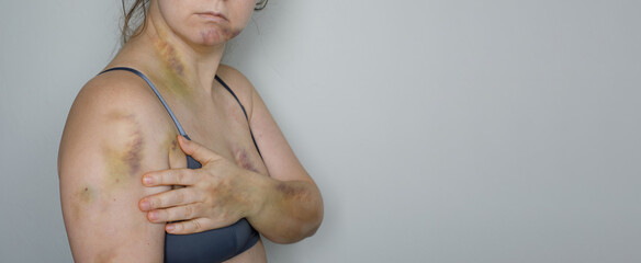 Life Hurts. Woman with bruise injury. Stop violence and car accident scar concept