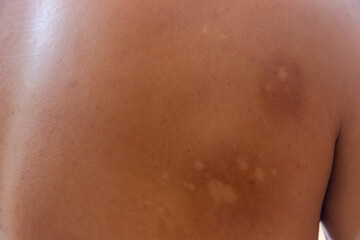Macro white Pityriasis or Tinea Versicolor on back skin,Used for skincare concept,Healthcare concept