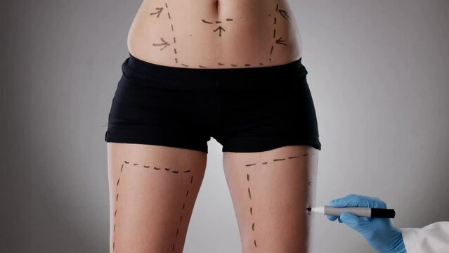 Thigh Abdominoplasty. Women Surgical Liposuction