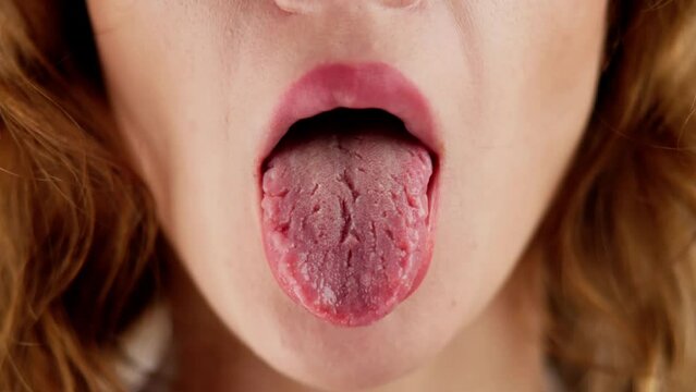 Dry Tongue Pain And Cracks