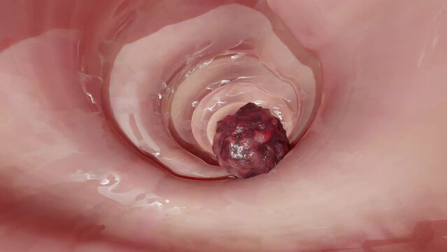 Colorectal cancer, malignant tumor in intestine, Endoscope inside colonoscopy, gut intestine, Colon polyp removal, colonic polyps search, Polypectomy, intestinal carcinoma, bowel neoplasia, 3d render 