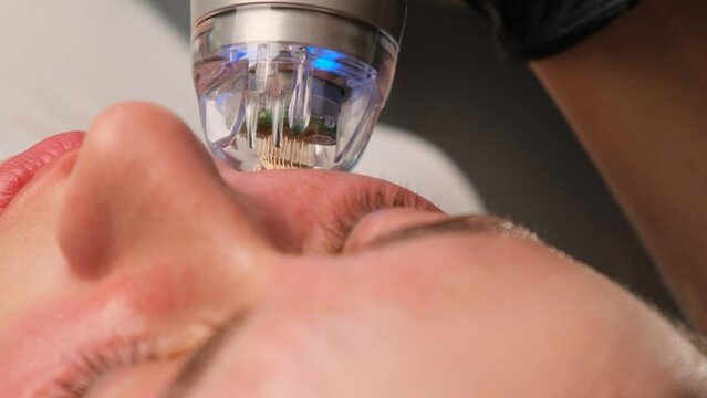 Close-up of a radiofrequency facelift procedure. Facial skin care, anti-aging facial rejuvenation. Radio wave face lifting in a cosmetology clinic. Close-up.