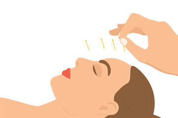 young beauty woman during procedure of acupuncture therapy- vector illustration - obrazy, fototapety, plakaty