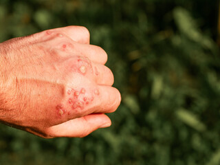 Hand with many blisters after wart treatment. Green grass background out of focus. Dermatology and skin treatment.