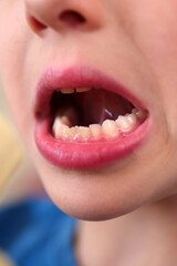 dental structure disorder in children, close-up of a child's teeth,