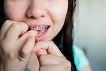 Close up of young woman with braces using dental floss to clean her teeth in the bathroom. Oral Hygiene routine
