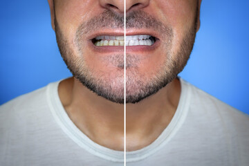Close-up of a man's mouth, before and after teeth care.
