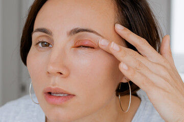 Close up female patient's infected eye. The brown-eyed woman staring at the camera has an external...