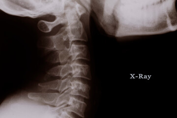 x ray of Skull film.