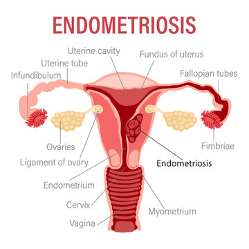 Endometriosis, schematic illustration of the uterus, diseases of the female reproductive system. Medical infographic banner. Vector