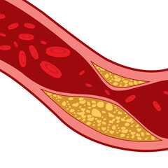 Fat in the arteries, atherosclerosis, red blood cells